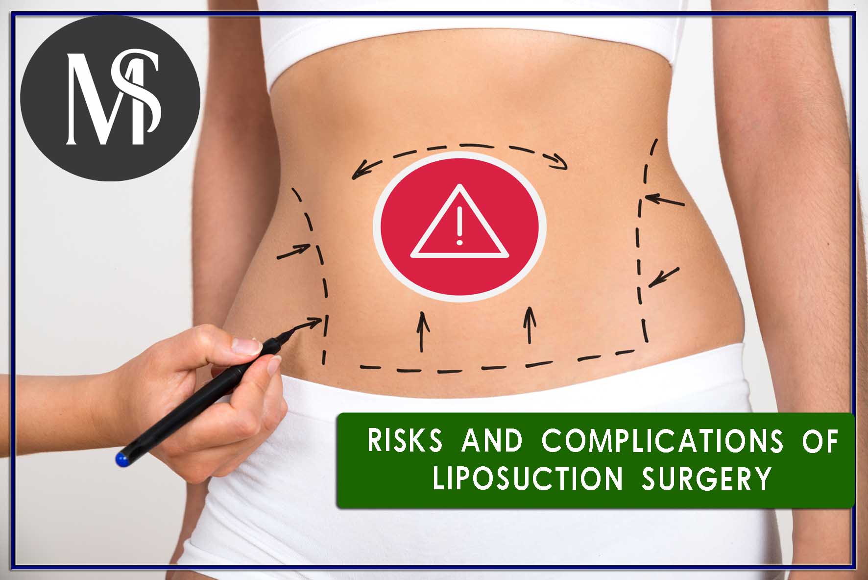 Risks and complications of liposuction surgery - what to do